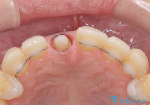 前歯をきれいなセラミックにしたい。の治療中