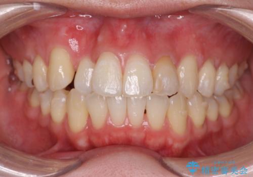 引っ込んだ前歯を並べたい マウスピースと部分ワイヤーのコンビネーション矯正の治療中