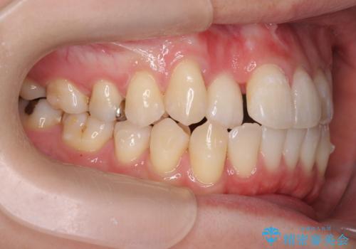 引っ込んだ前歯を並べたい マウスピースと部分ワイヤーのコンビネーション矯正の治療中