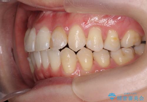 引っ込んだ前歯を並べたい マウスピースと部分ワイヤーのコンビネーション矯正の治療中