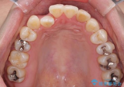 引っ込んだ前歯を並べたい マウスピースと部分ワイヤーのコンビネーション矯正の治療中