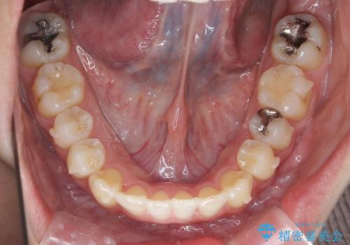 引っ込んだ前歯を並べたい マウスピースと部分ワイヤーのコンビネーション矯正の治療中