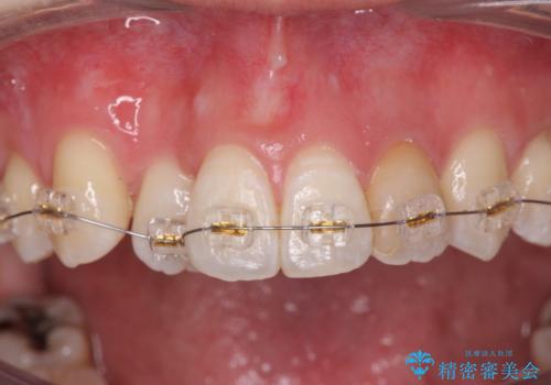 引っ込んだ前歯を並べたい マウスピースと部分ワイヤーのコンビネーション矯正の治療中