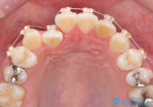 引っ込んだ前歯を並べたい　マウスピースと部分ワイヤーのコンビネーション矯正の治療中