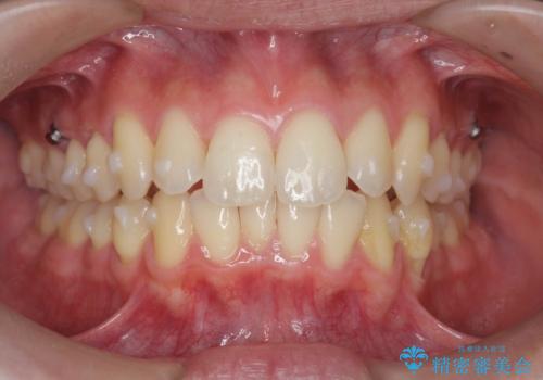 過蓋咬合・上顎前突・叢生を改善するマウスピース矯正の治療前