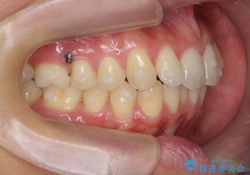 過蓋咬合・上顎前突・叢生を改善するマウスピース矯正の治療前