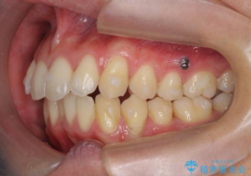 過蓋咬合・上顎前突・叢生を改善するマウスピース矯正の治療前