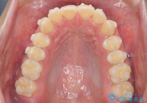 過蓋咬合・上顎前突・叢生を改善するマウスピース矯正の治療前