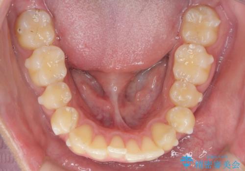 過蓋咬合・上顎前突・叢生を改善するマウスピース矯正の治療前