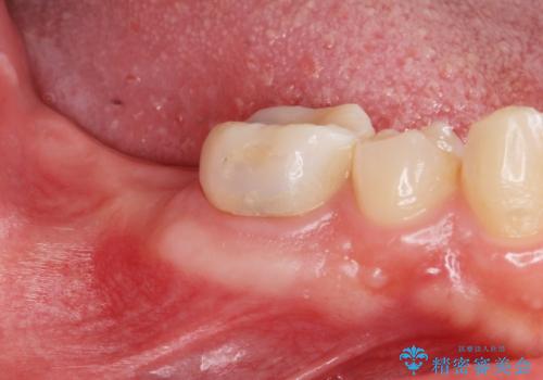 銀歯を白くしたい。(インプラント治療)の治療前