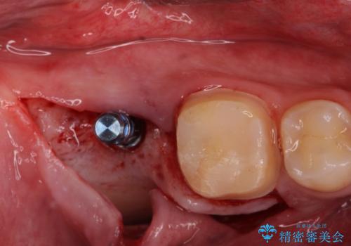 銀歯を白くしたい。(インプラント治療)の治療中