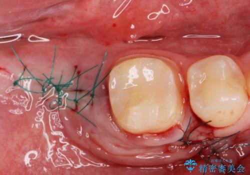 銀歯を白くしたい。(インプラント治療)の治療後