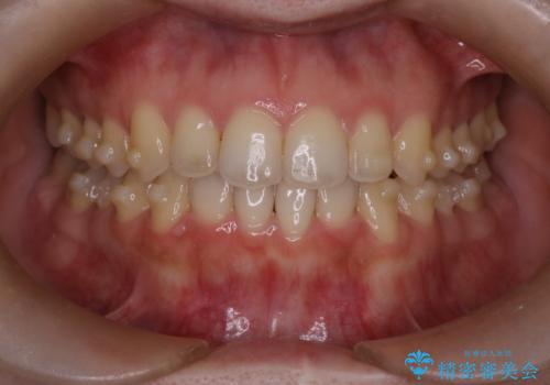 【インビザライン】オープンバイトを治したいの治療中