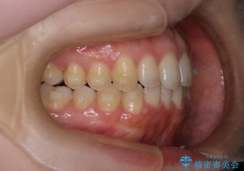 【インビザライン】オープンバイトを治したいの治療中