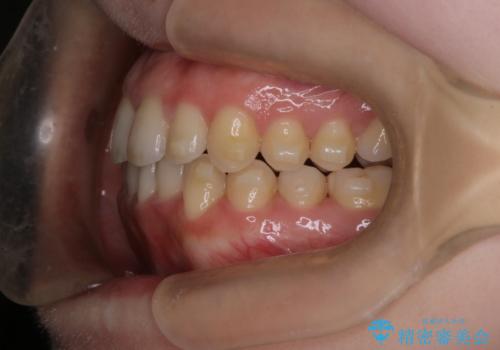 【インビザライン】オープンバイトを治したいの治療中