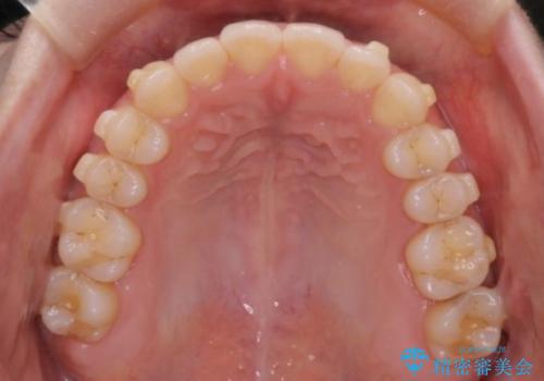【インビザライン】オープンバイトを治したいの治療中
