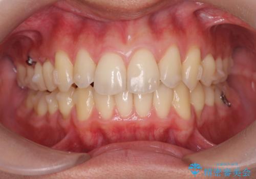 過蓋咬合・上顎前突・叢生を改善するマウスピース矯正の治療中