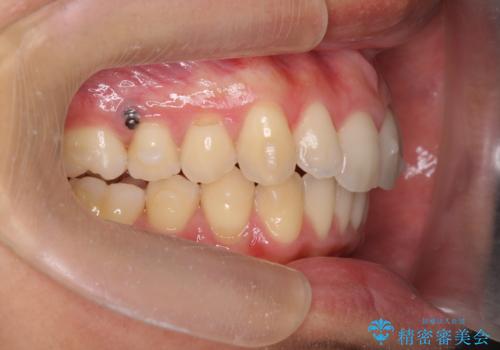 過蓋咬合・上顎前突・叢生を改善するマウスピース矯正の治療中