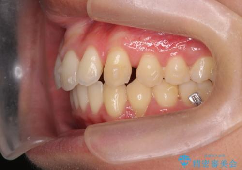 過蓋咬合・上顎前突・叢生を改善するマウスピース矯正の治療中