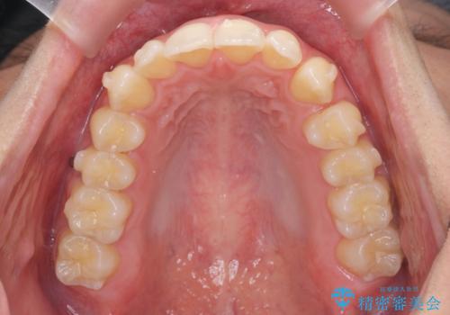 過蓋咬合・上顎前突・叢生を改善するマウスピース矯正の治療中