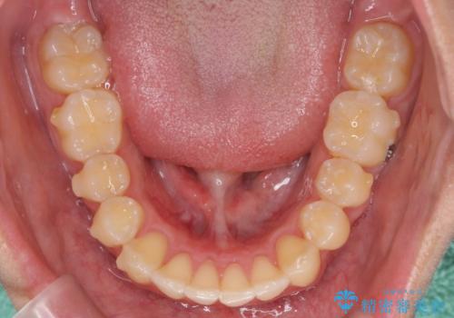 過蓋咬合・上顎前突・叢生を改善するマウスピース矯正の治療中