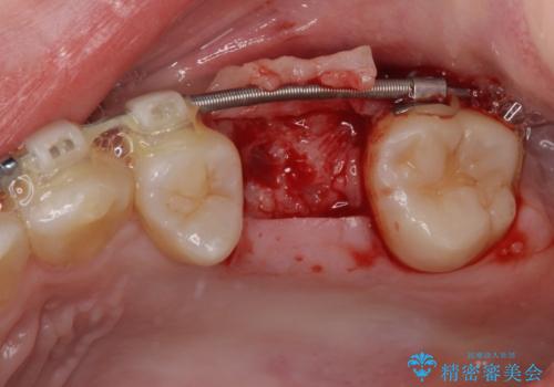 矯正の後戻りと奥歯の欠損 ワイヤー矯正とインプラント治療の治療前
