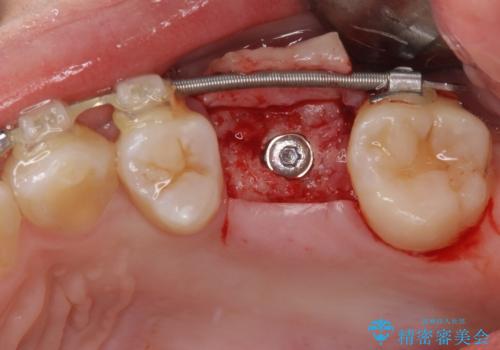 矯正の後戻りと奥歯の欠損 ワイヤー矯正とインプラント治療の治療中