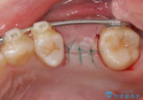矯正の後戻りと奥歯の欠損 ワイヤー矯正とインプラント治療の治療後