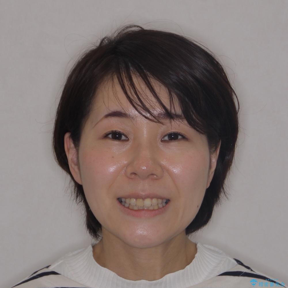 【モニター】後戻りでできた隙間 ワイヤー装置での再矯正の治療後(顔貌)