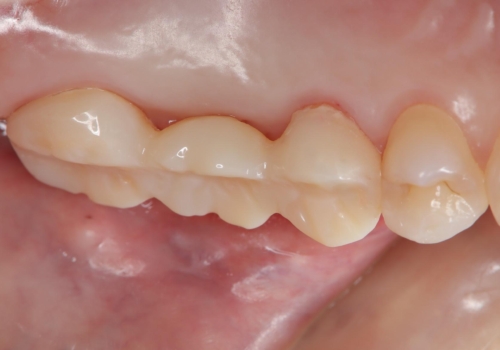 メタルフリー治療 保険の金属ブリッジから、自費のセラミックブリッジへの治療中