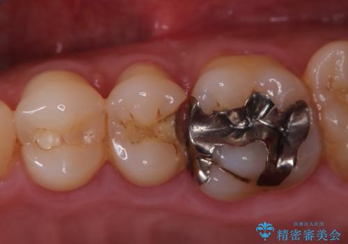 【セラミックインレー】他院で詰めた銀歯がフロスをしたら取れた!の症例 治療前