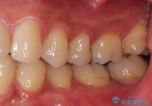 【セラミックインレー】他院で詰めた銀歯がフロスをしたら取れた!の治療後