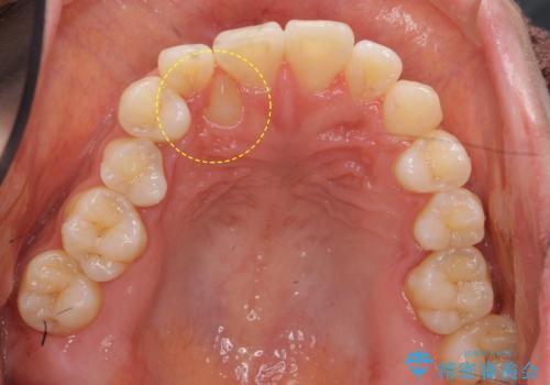 犬歯が歯ぐきにうまっている 真ん中のずれ、出っ歯を治したいの治療前