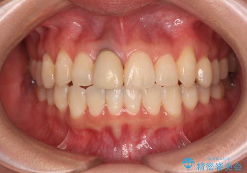 前歯をきれいなセラミックにしたい。の症例 治療前