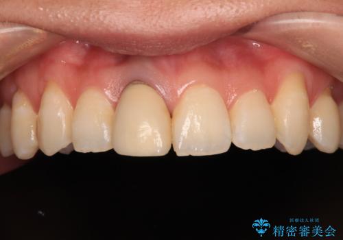 前歯をきれいなセラミックにしたい。の治療前