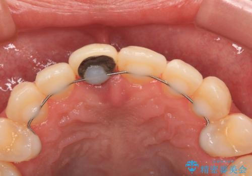 前歯をきれいなセラミックにしたい。の治療前