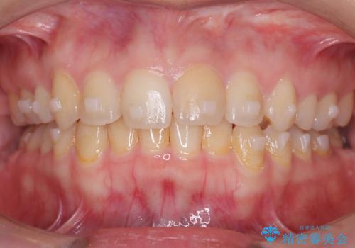 矯正後の後戻り インビザラインで改善の治療中