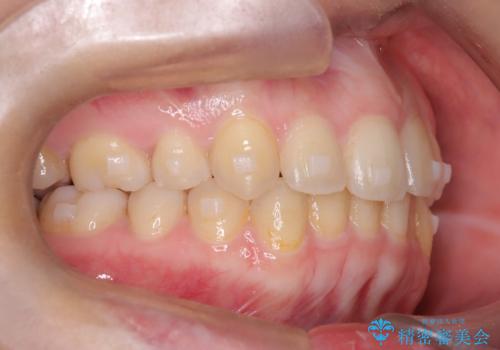 矯正後の後戻り インビザラインで改善の治療中