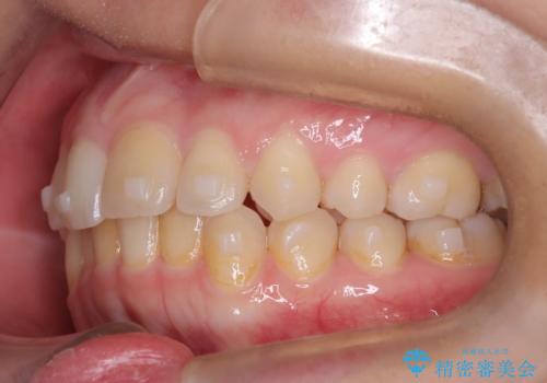 矯正後の後戻り インビザラインで改善の治療中