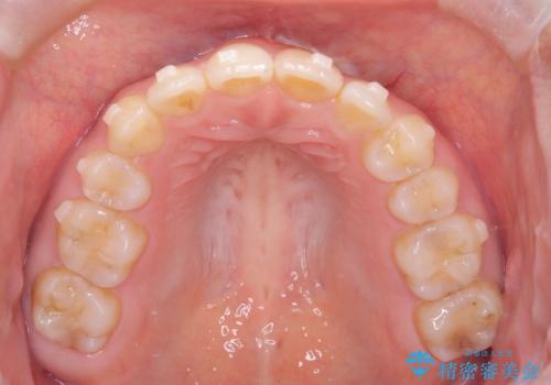 矯正後の後戻り インビザラインで改善の治療中