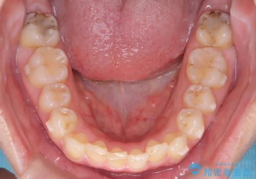 矯正後の後戻り インビザラインで改善の治療中