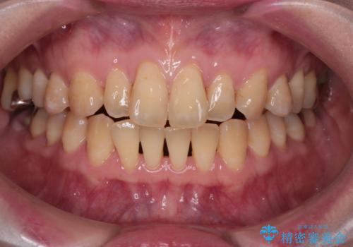 【インビザライン】前歯の捻れとオープンバイトの症例 治療前
