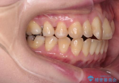 【インビザライン】前歯の捻れとオープンバイトの治療前
