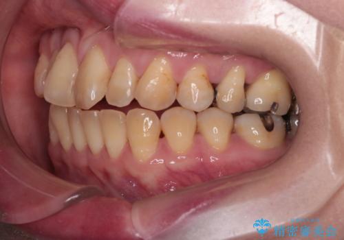 【インビザライン】前歯の捻れとオープンバイトの治療前