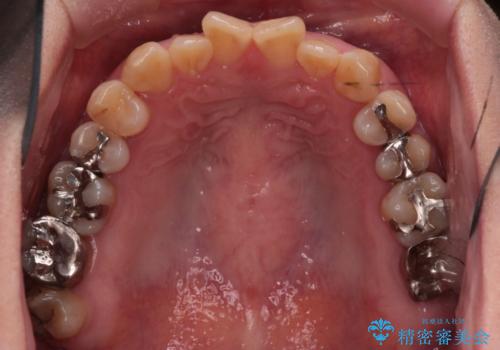 【インビザライン】前歯の捻れとオープンバイトの治療前