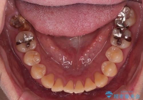 【インビザライン】前歯の捻れとオープンバイトの治療前