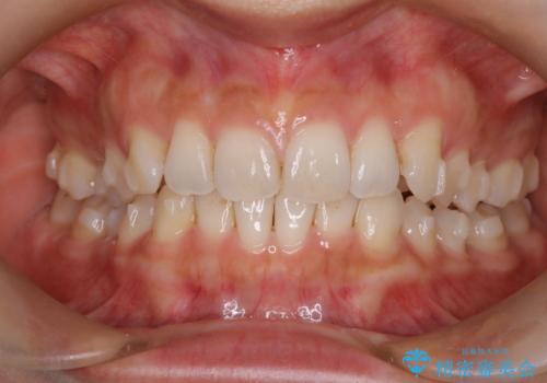 【インビザライン】前歯のねじれを治したいの治療中