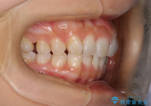 【インビザライン】前歯のねじれを治したいの治療中