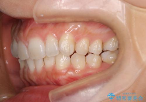 【インビザライン】前歯のねじれを治したいの治療中