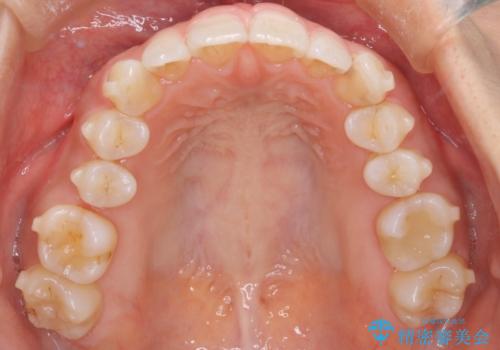【インビザライン】前歯のねじれを治したいの治療中